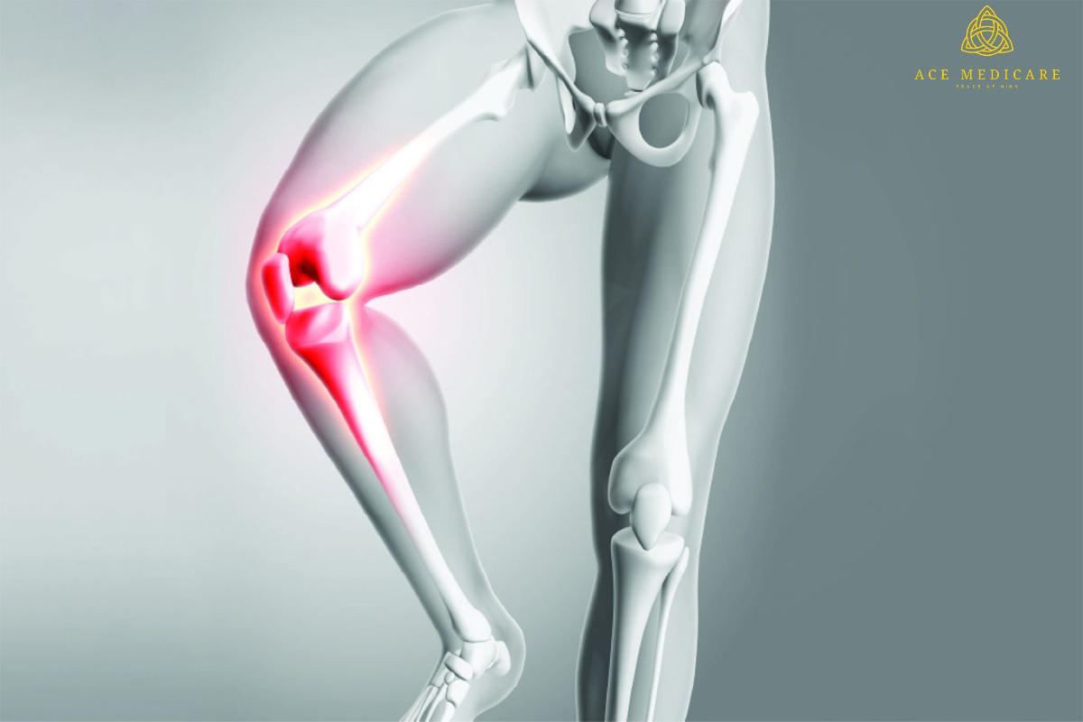The Ultimate Guide to Knee Replacement Implants: Everything You Need to Know